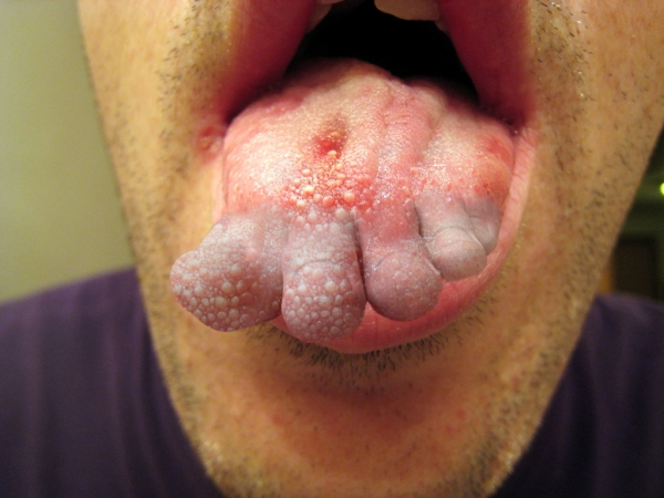 Creation of Do I Have Athlete's Tongue?: Step 2